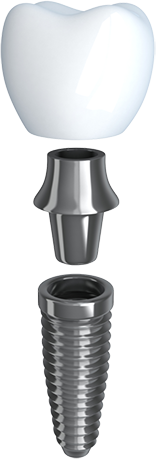 diagram of a dental implant